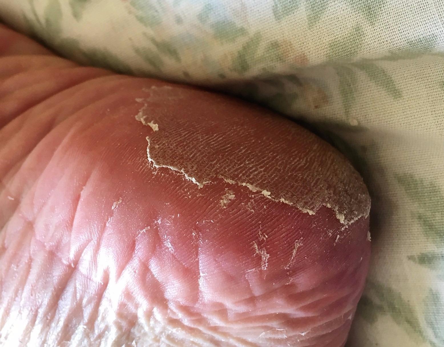 Purederm Foot Peeling Mask for Dry Cracked Feet, Exfoliating Treatment for Dead Skin & Calluses for Baby Soft Feet, 3 Pairs customer photo 1