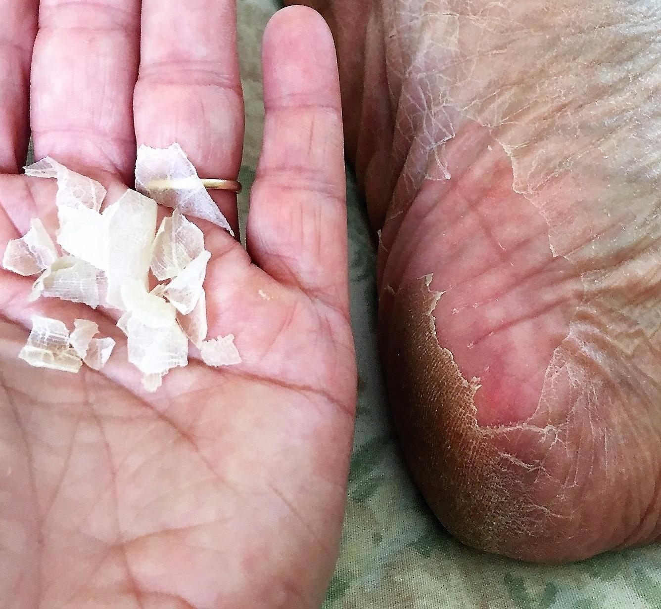 Purederm Foot Peeling Mask for Dry Cracked Feet, Exfoliating Treatment for Dead Skin & Calluses for Baby Soft Feet, 3 Pairs customer photo 2