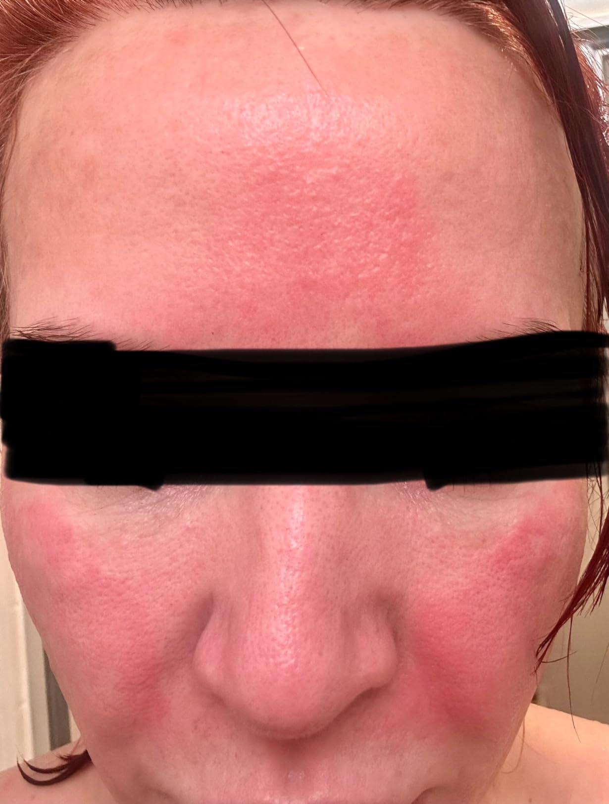 HigherDOSE Red Light Therapy Mask - FSA Eligible FDA Cleared LED Face Mask with Near Infrared Light Technology - Clinically Proven At-Home Red Light Mask Therapy for Face - Wrinkles & Glass Skin customer photo 2