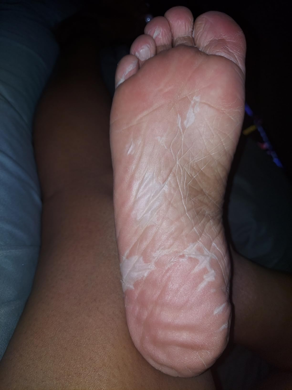 DERMAL KOREA Foot Peeling Mask 3 Pack For Dry Foot And Cracked Heel & Callus With Aloe Vera And Collagen - Exfoliating Peel Mask With AHA, BHA, & PHA For Moisturizing, Soothing & Refreshing Feet customer photo 1