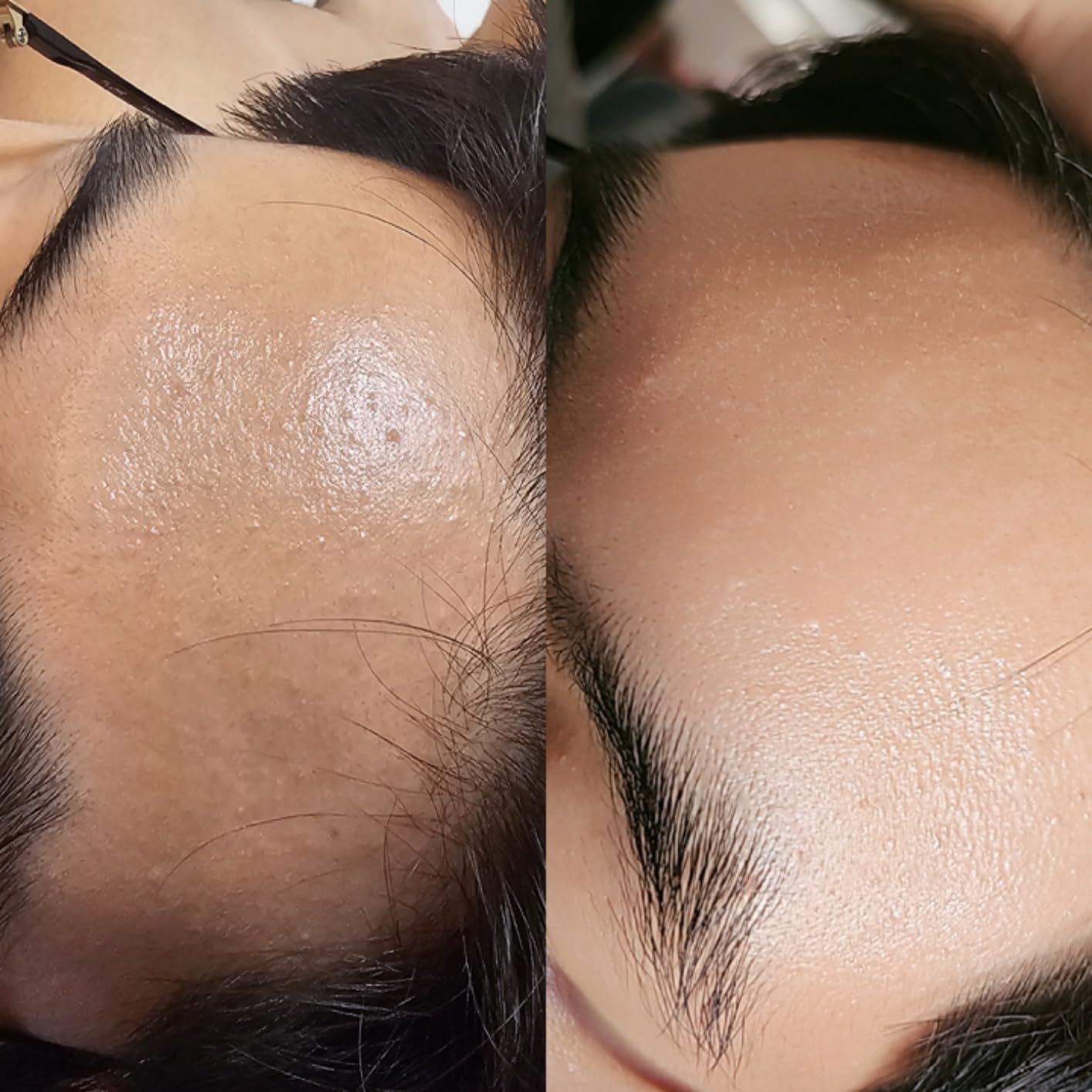 Medicube Age-R ATS Air Shot - Microneedling Pore Tightening Skin Care Device for Enhanced Absorption, Pore Refinement, and Smoother Skin Texture - Exfoliation, Skin Rejuvenation - Korean Skin Care customer photo 1