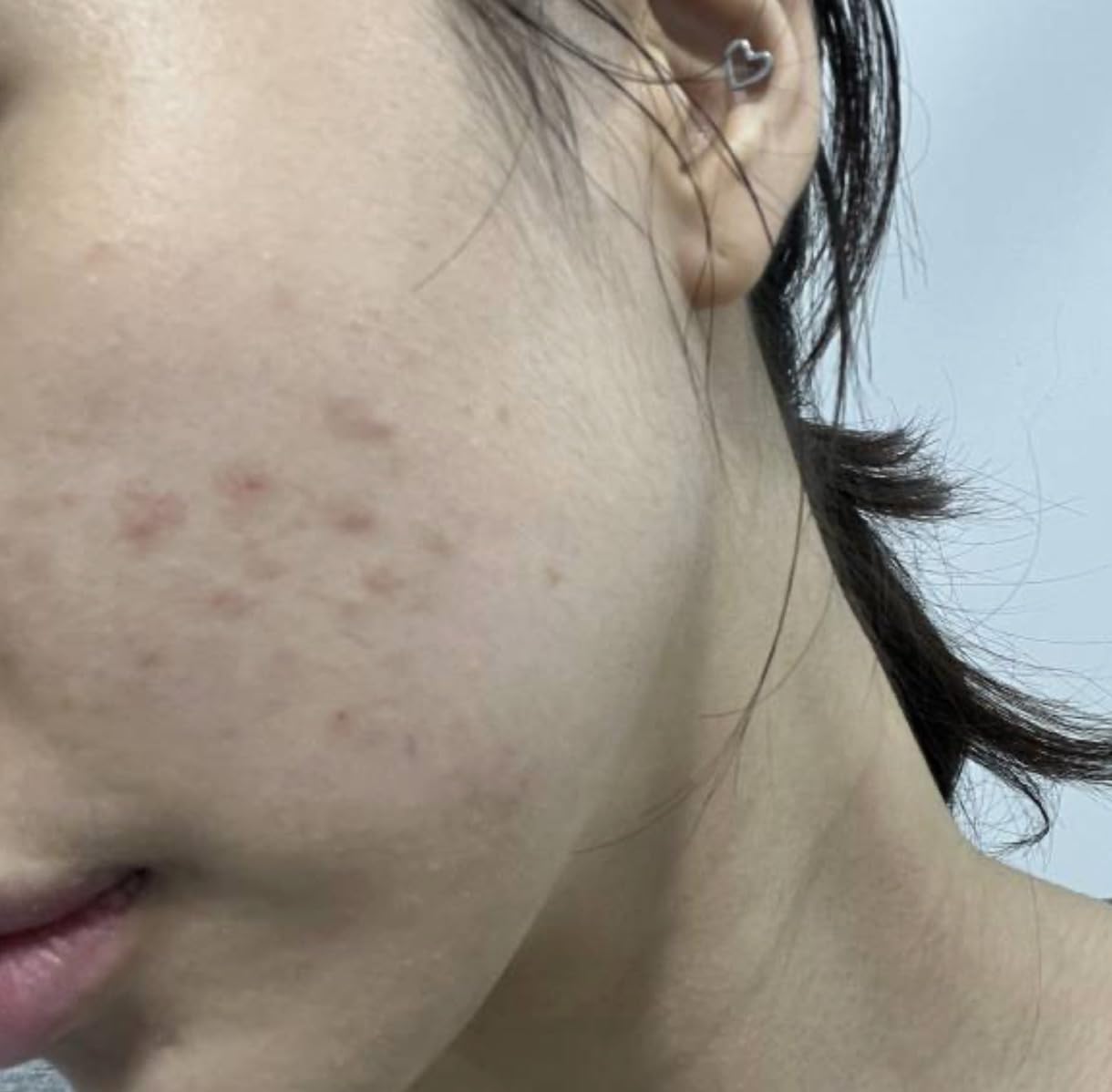 Medicube Age-R ATS Air Shot - Microneedling Pore Tightening Skin Care Device for Enhanced Absorption, Pore Refinement, and Smoother Skin Texture - Exfoliation, Skin Rejuvenation - Korean Skin Care customer photo 2