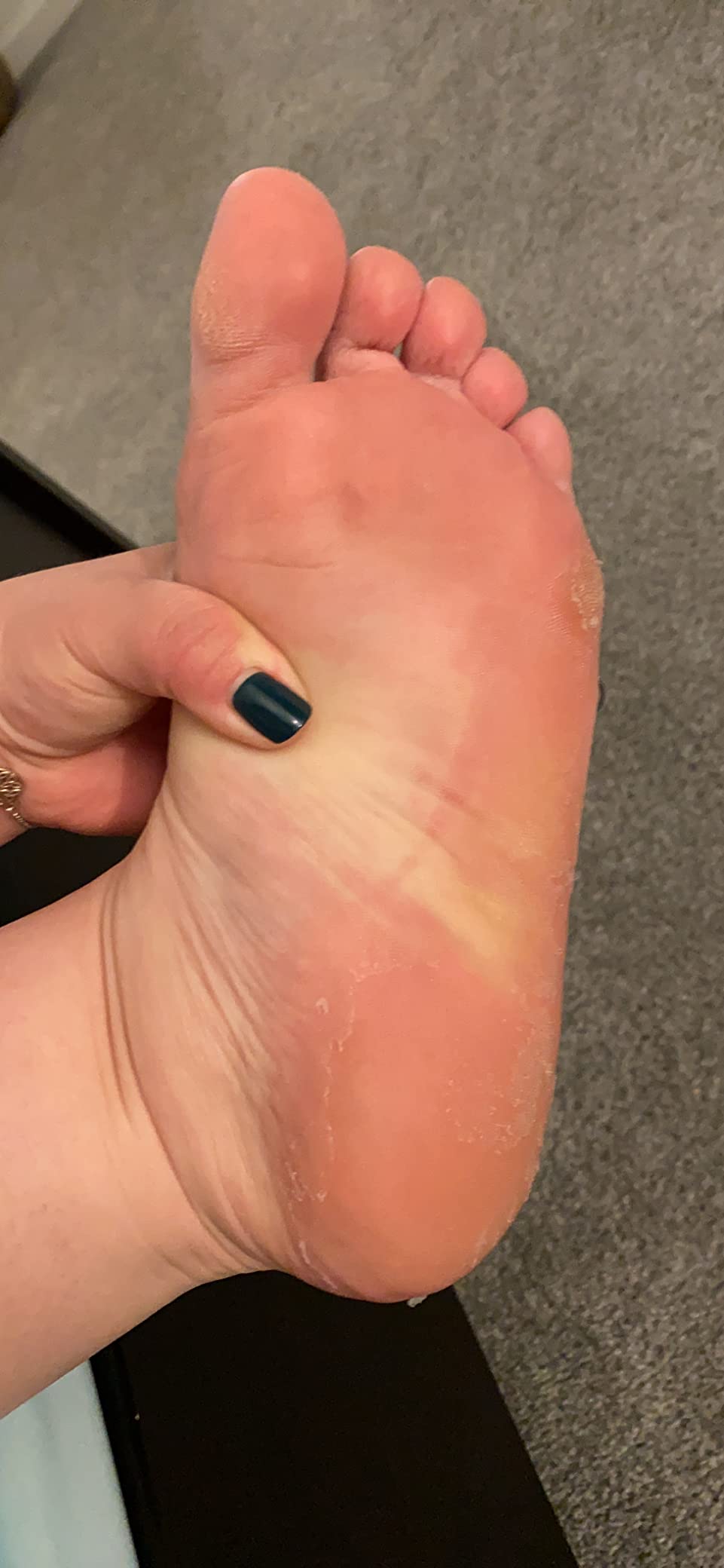 Oh K! Foot Peel Mask - Pomegranate - Foot Peeling Mask for Dry Feet and Cracked Heels - Feet Exfoliant with Pomegranate and Coconut Oil - 1 Pair customer photo 2