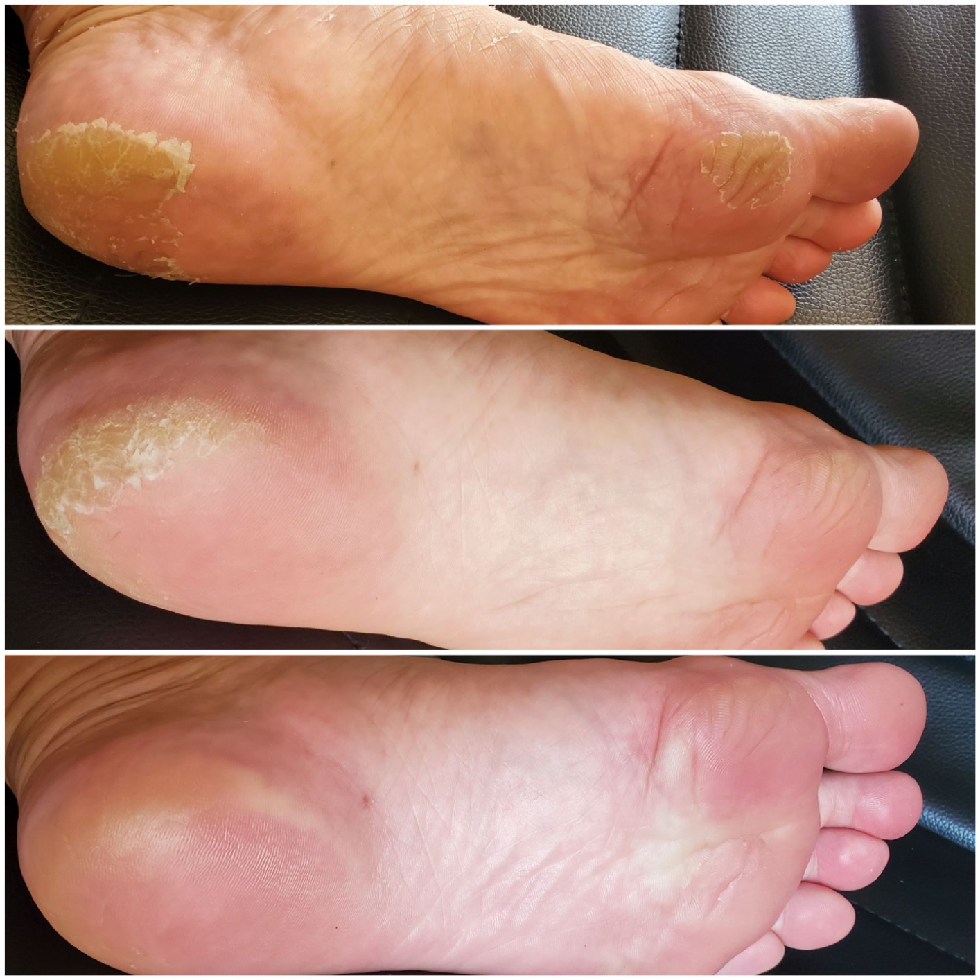 KOCOSTAR Premium Foot Therapy | AHA Exfoliating Foot Peel Mask for Cracked Heels & Callus Removal | Soft Feet in 10 Days | Korean Skincare (5 pack) customer photo 1
