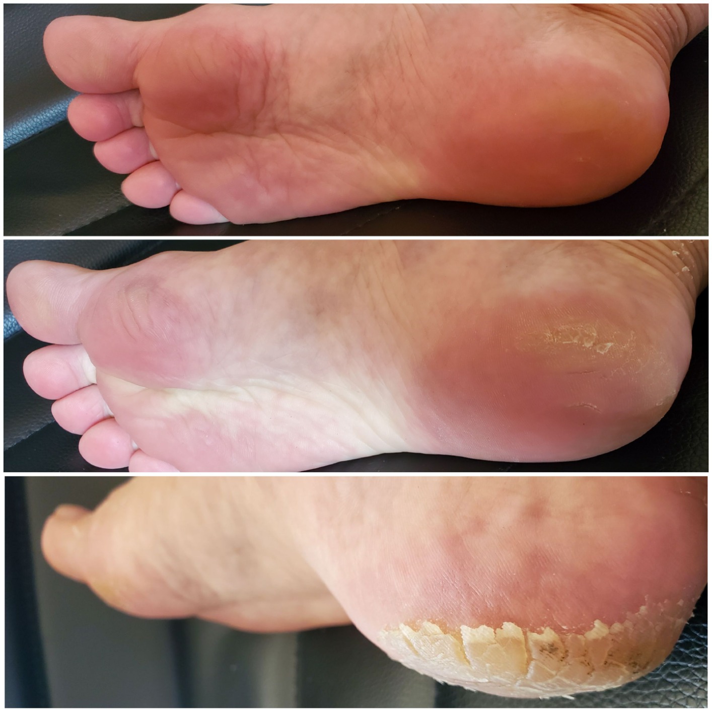 KOCOSTAR Premium Foot Therapy | AHA Exfoliating Foot Peel Mask for Cracked Heels & Callus Removal | Soft Feet in 10 Days | Korean Skincare (5 pack) customer photo 2